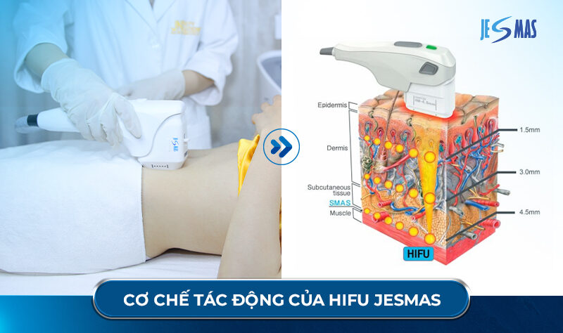 Cách chọn máy hifu phù hợp cho Spa