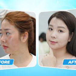 Nên trẻ hóa da bằng phương pháp nào để kịp Tết?